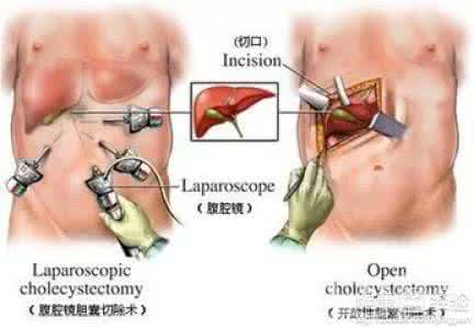 治疗慢性胆囊炎的偏方 慢性胆囊炎的病因 慢性胆囊炎的症状与治疗