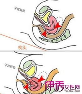 子宫前位是什么意思 子宫前位是什么意思 子宫前位需要注意什么