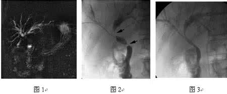 介入治疗与护理 恶性阻塞性黄疸介入治疗护理体会