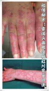 当归川穹白芍 祖传秘方:雷诺氏病根治桃红川穹当归汤