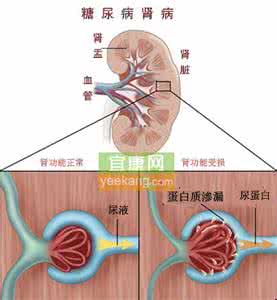 糖尿病肾脏疾病 十项措施帮您预防糖尿病性肾脏疾病的发生与发展