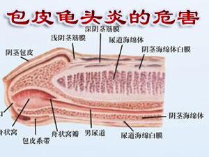 龟头炎射精有点痛红点 经常手淫龟头痛 谨防龟头炎