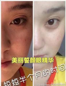 怎样去脂肪粒 脂肪粒 怎样去祛斑