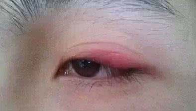 眼皮红肿是怎么消除 眼皮红肿怎么办