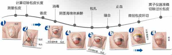 小儿包茎如何处理 小儿包茎 小儿包茎怎么处理