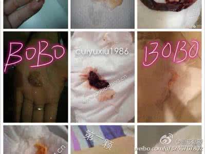 参茸鞭丸吃多久见效 女性福音：产后脱肛三天见效吧参汤