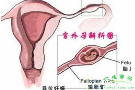 土豪取钱戴人皮面具 两性:戴面具的宫外孕
