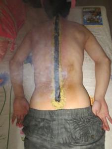 长蛇灸做一次多少钱 给大师兄做脊椎铺灸，即长蛇灸