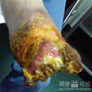 气性坏疽 气性坏疽 这些因素会导致气性坏疽