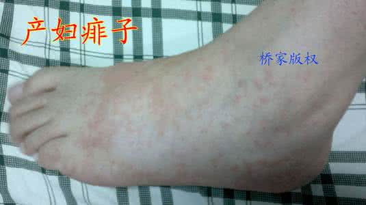 热痱子症状图片 产妇起热痱子图片 坐月子出痱子怎么办