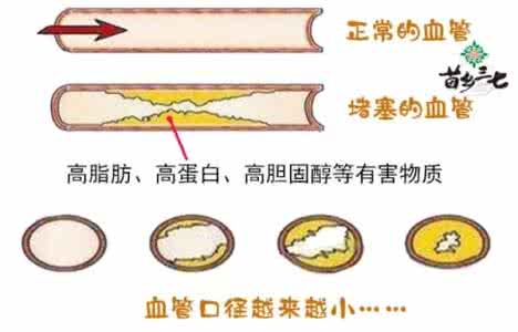 血管堵塞几岁开始 血管是这样一天天堵塞的？从明天开始吃三七压压惊！