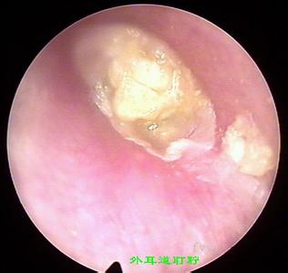 耵聍栓塞是什么 耵聍栓塞 什么是耵聍拴塞
