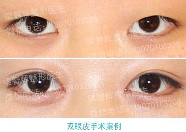 双眼皮手术前准备 双眼皮手术前准备 双眼皮手术前的准备