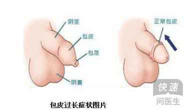 小儿包茎如何处理 小儿包茎如何处理 小儿包茎的种类