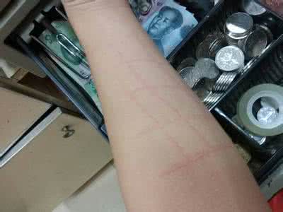 怎么治疗人工性荨麻疹 人工性荨麻疹 人工性荨麻疹怎么治疗