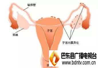 子宫肌瘤小腹坠疼 “小腹婆”要当心 子宫肌瘤最易找上门
