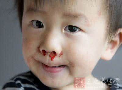 什么病会导致流鼻血 6种病都能导致流鼻血