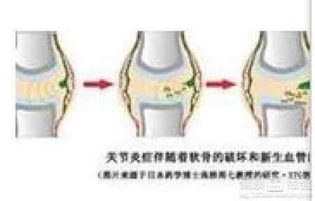 类风湿关节炎除根偏方 什么是类风湿关节炎 预防治疗偏方有哪些