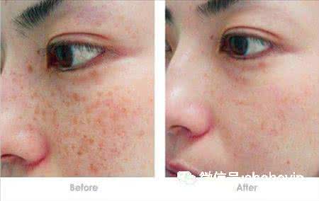 阿司匹林可以祛斑吗 阿司匹林祛斑 阿司匹林加点“它”，祛斑只要一夜，不出七天肌肤返老还童