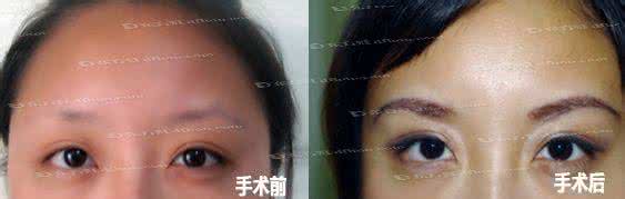 眉毛移植术 眉毛移植术 眉毛移植 术前术后的了解