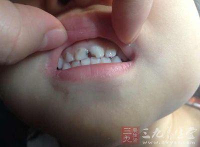 牙齿上有白色分泌物臭 牙齿上有一物竟会漏财