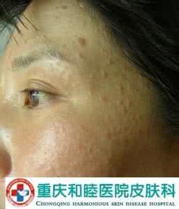 医治痤疮有效方法 医治痤疮方法是什么 怎么医治呢