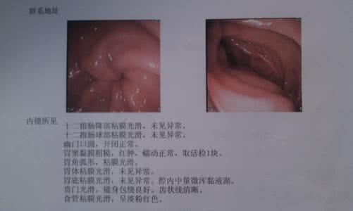 慢性肠胃炎不能吃什么 慢性肠胃炎什么症状