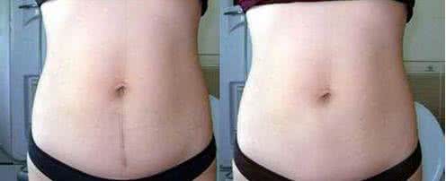 青春痘的疤痕修复方法 剖腹产疤痕修复的方法