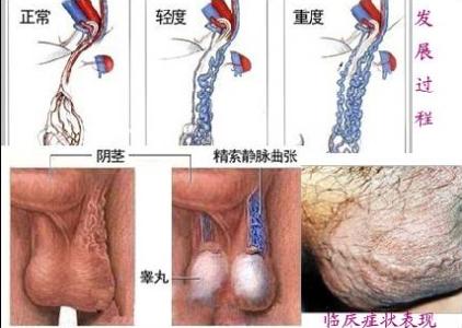 精索静脉曲张能自愈吗 精索静脉曲张的5个饮食保健方子