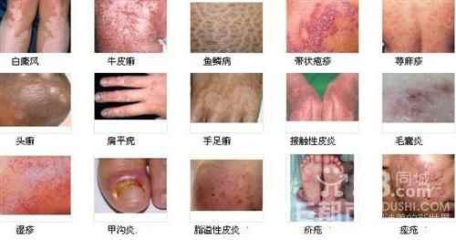 彭静山：治疗痤疮、乳腺增生、荨麻疹等疾病的截根疗法