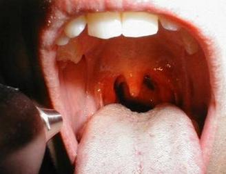 咽喉炎不能吃什么 咽喉炎能吃香菇吗 必须要知道