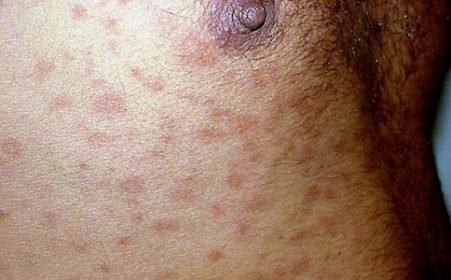 子宫肌瘤的典型症状 瘤型麻风 瘤型麻风的典型症状