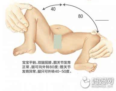新生儿髋关节脱位 新生儿髋关节脱位对应方法