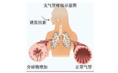 慢性支气管炎 慢性支气管炎【支气管哮喘】