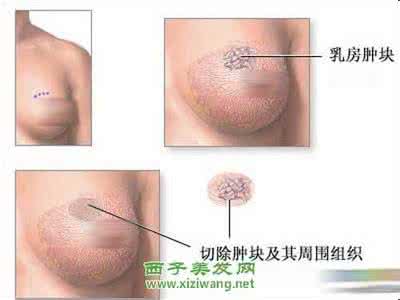 乳腺癌早期症状会疼吗 乳腺癌早期症状 怎么预防乳腺癌_乳腺癌早期症状