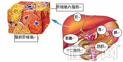 脂肪肝及肝脏硬度检查 关于肝脏の3-脂肪肝
