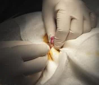 女性结扎的副作用 女性结扎有什么危害？女性结扎的副作用