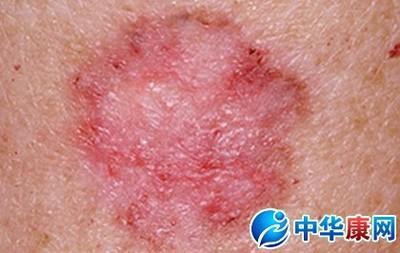 谢霆锋皮肤癌能活多久 皮肤癌 洗澡过多会诱发皮肤癌吗?