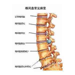 针灸治疗腰椎骨质增生 一种中药汤剂治疗腰椎骨质增生