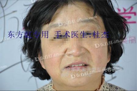 有谁做过激光祛斑 手上有斑怎么做可以祛斑
