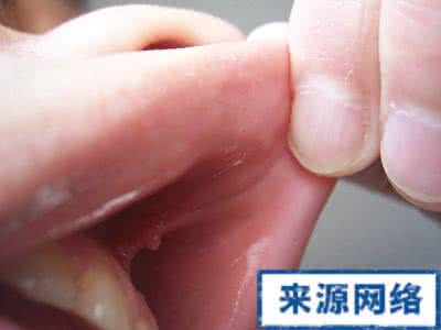 艾滋病患者的口腔病变 艾滋病患者的口腔病变 患上艾滋病 口腔也会发生这事!