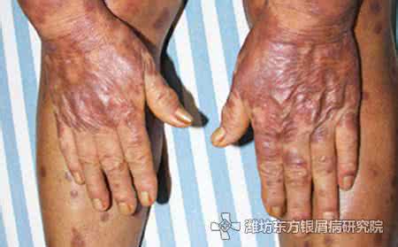 银屑病发病原因 脓疱型银屑病 它有哪些发病原因