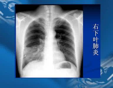 肺炎的治疗方法 肺炎的治疗 肺炎的治疗？_肺炎的治疗