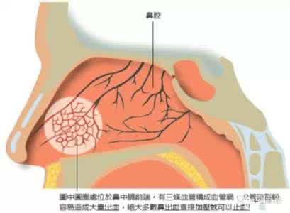 中医治疗鼻出血 出鼻血 中医止鼻血竟如此简单