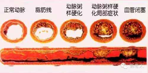 老年人血管堵塞 血管年龄 人过四十五就怕血管堵！专家送你4多食物，为血管驻龄~