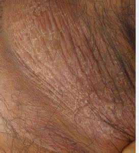 阴囊湿疹用什么药 阴囊湿疹用肤速宁