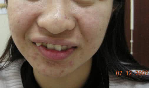 长痤疮粉刺怎么治疗 脸上长痤疮粉刺怎么办 男生脸上长粉刺痤疮怎么治