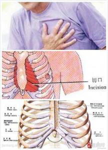 最快治疗肋软骨炎偏方 肋软骨炎怎么引起的 肋软骨炎的偏方