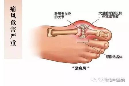 年轻人痛风能活几十岁 痛风，痛了几十年，才明白这4点，早知道就好了！