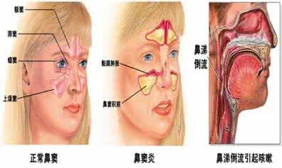 鼻窦炎怎么治 鼻窦炎怎么治 怎样解决鼻窦炎